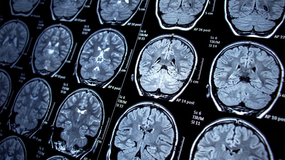 A grid of brain MRI scans on a light box.